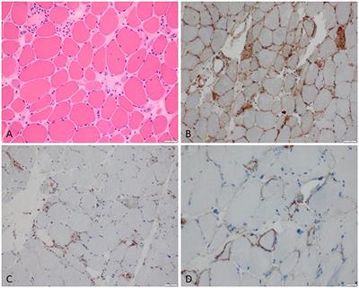 Biomarkers in Inflammatory Myopathies—An Expanded Definition